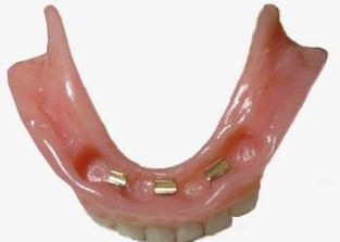 neerhalen stuiten op Overjas Alles over implantaten - Kliniek voor… | De Kliniek voor Tandheelkunde