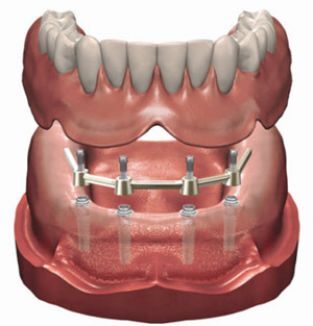 Extractie Herrie Geleend Alles over implantaten - Kliniek voor… | De Kliniek voor Tandheelkunde